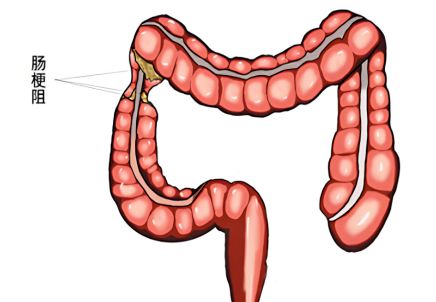 推荐从“肠”计议肠梗阻知识大起底这份科普请收好!(图2)