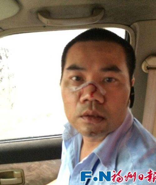 福州热心公交司机清路障被断枝砸中鼻梁缝七